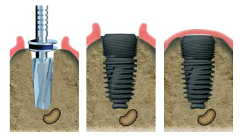 implants dentaires romainville